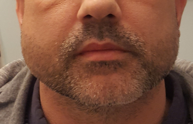 Bruxismo y asimetria por hipertrofia del masetero