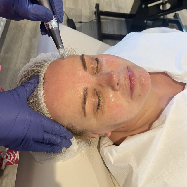 Micro-Needling &amp; BBGlow combined 