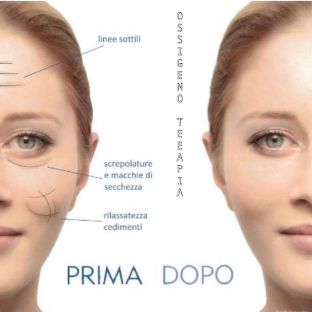 BIORIVITALIZZAZIONE SENZA AGHI- no time solution