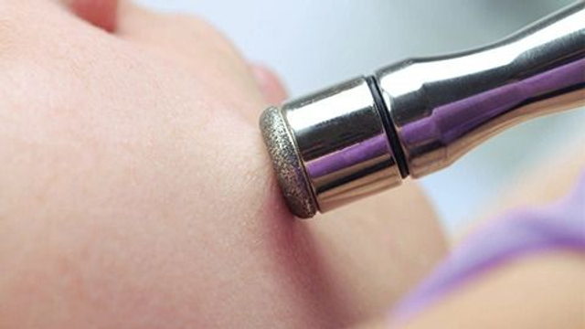 Microdermabrasion