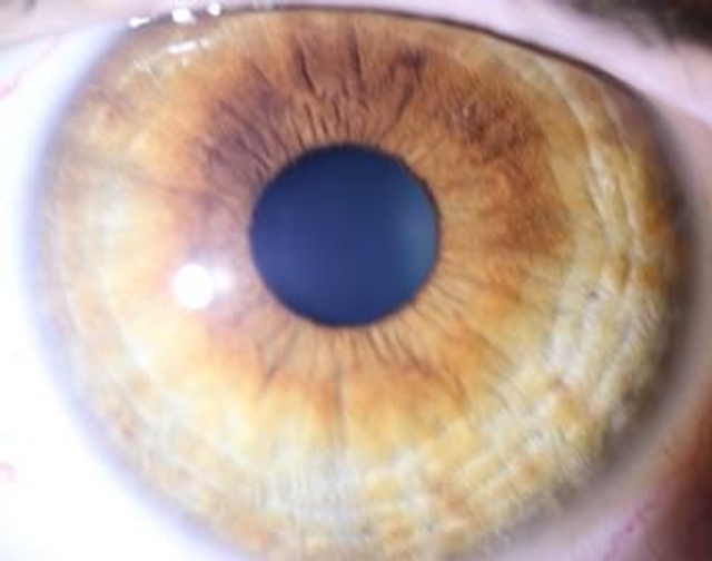 Iridologie Perfectionnement Système Nerveux