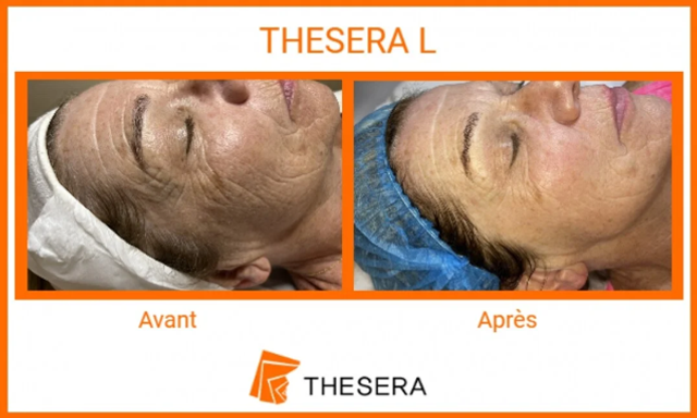 Thesera L