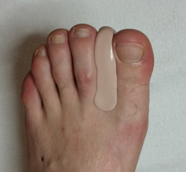 Fertigung einer einteiligen unilateralen und bilateralen Nagelkorrekturspange F1,8