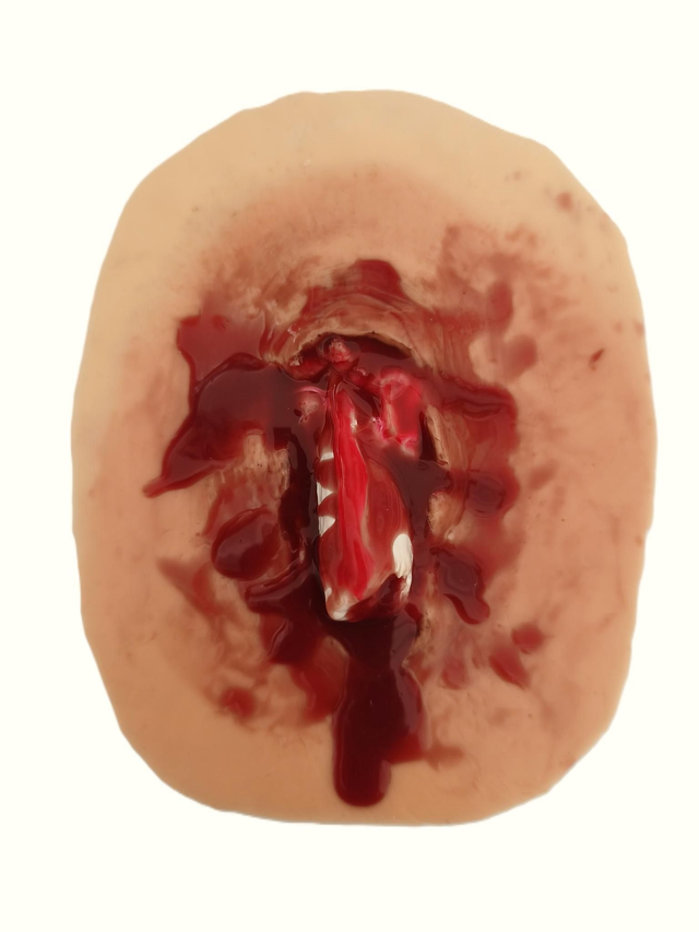 Ανοιχτό κάταγμα οστού 