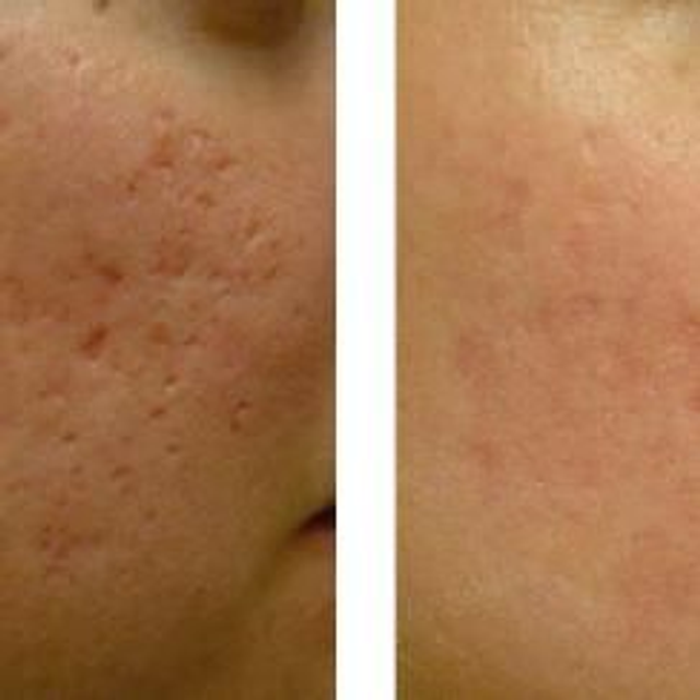 Trattamento cicatrici