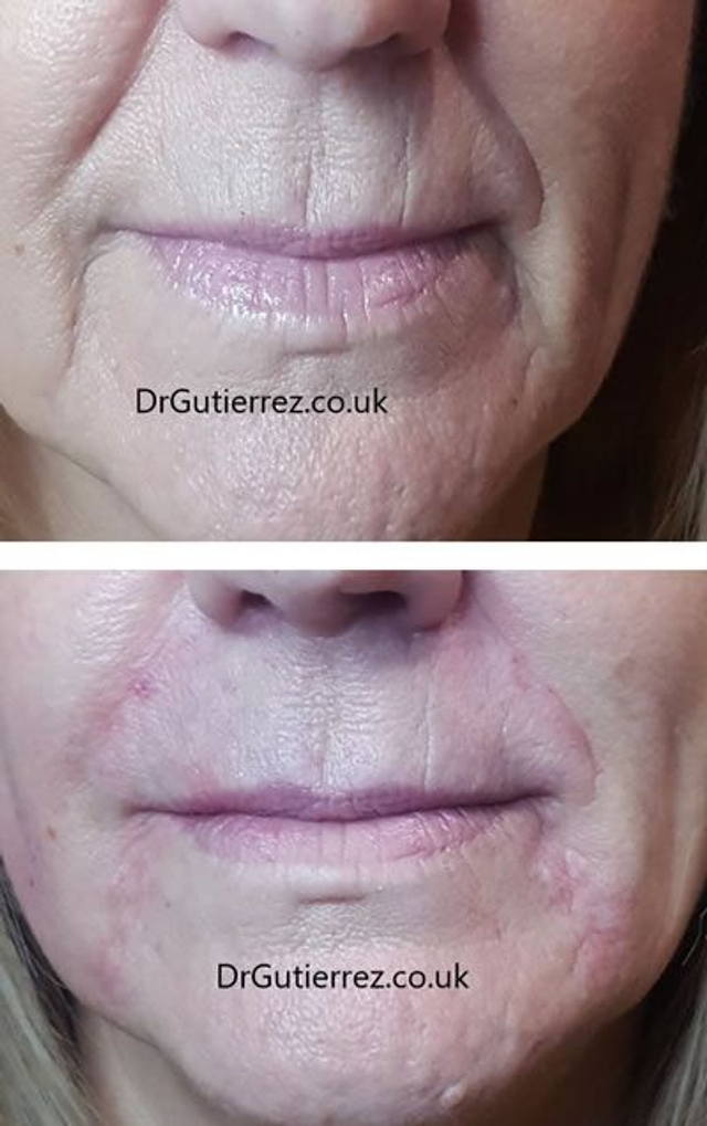 Tercio inferior (1 vial relleno de acido hialuronico)