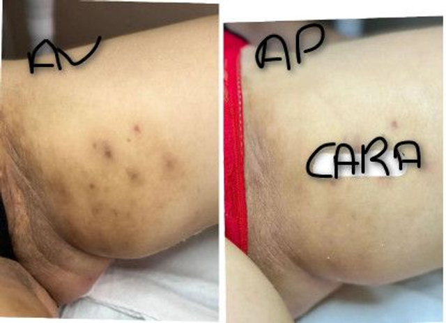 Creme éclaircissant pour cuisses,coude,taches