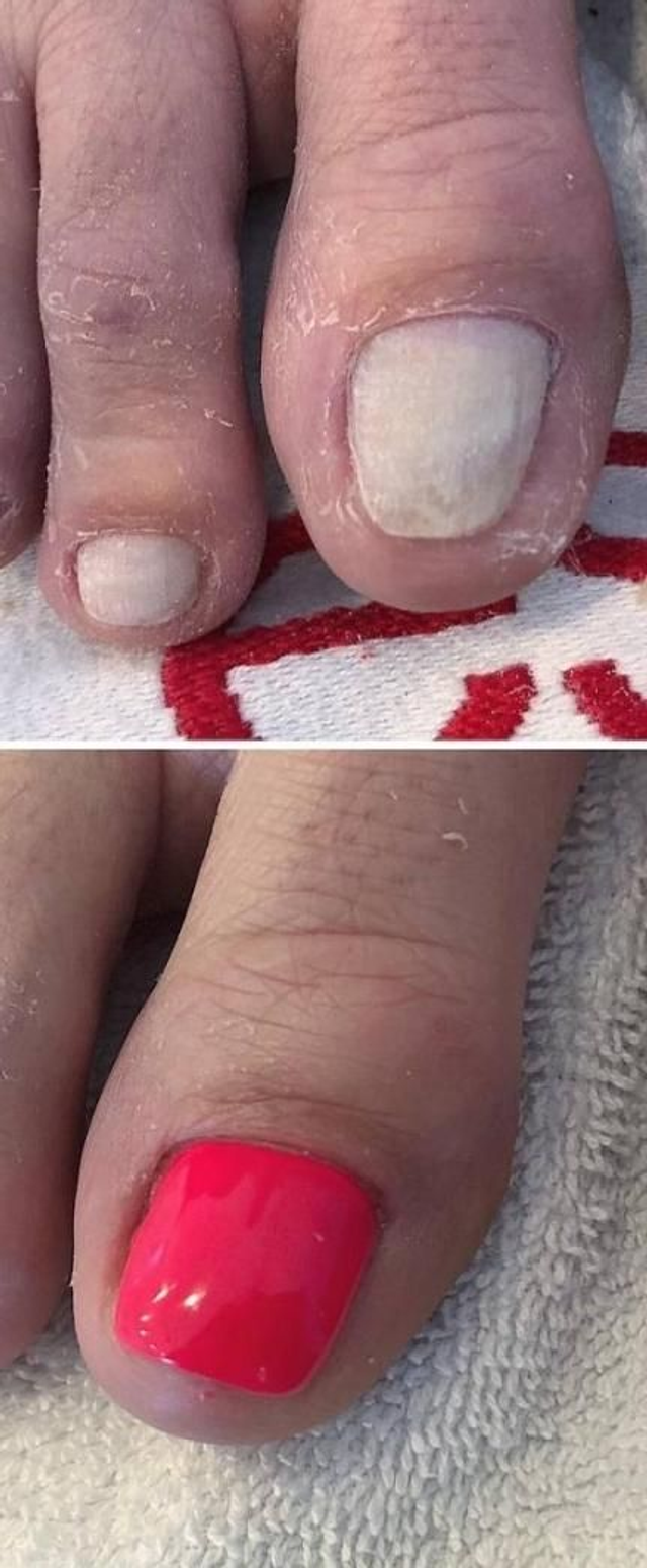 reconstruction gros orteil 