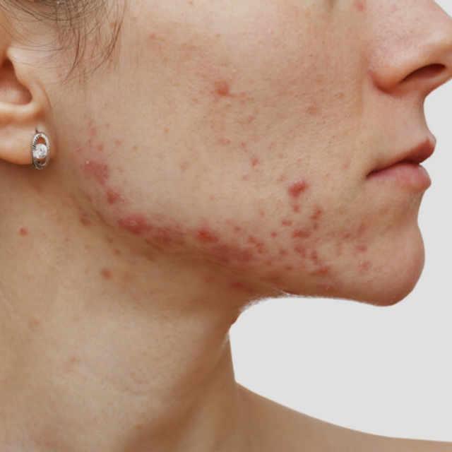 ACNÉ - CONTROL DERCUTANE