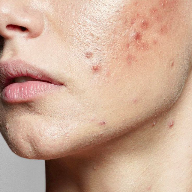 Gesichtsbehandlung Akne