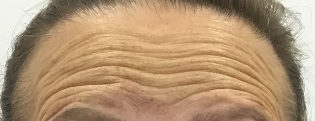 Arrugas de expresion