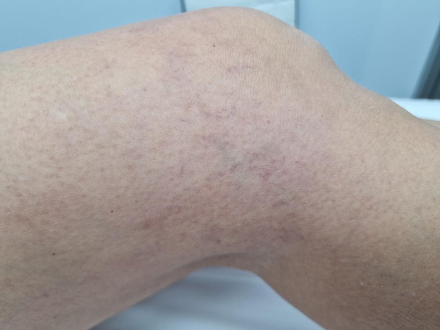 Varices y arañas vasculares (por sesion)