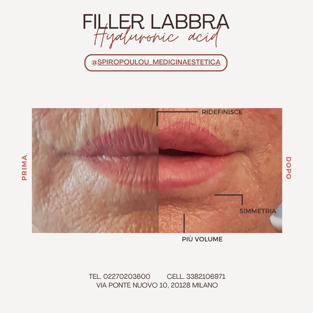 Lip filler