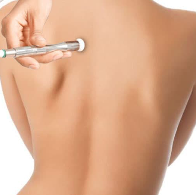 Microdermabrasion Of The Back