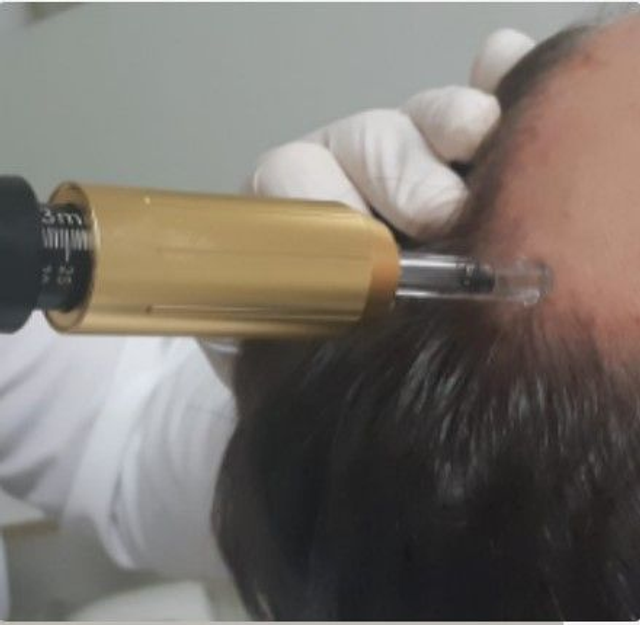  Alopecia Masculina /Feminina Pressurizada