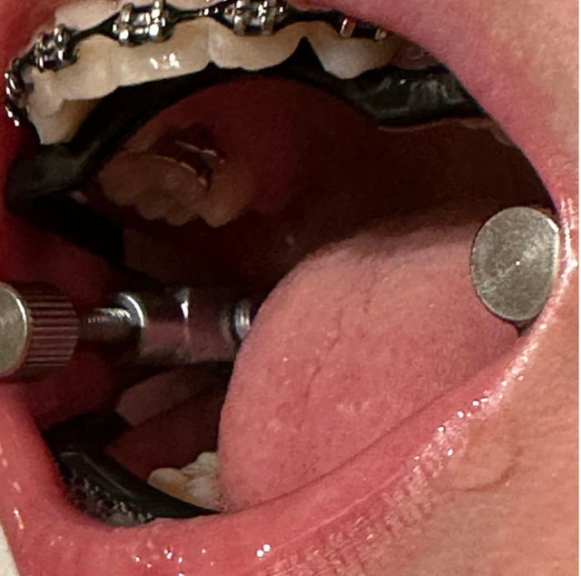 The Gobstopper Gag Keeps the slaves mouth open