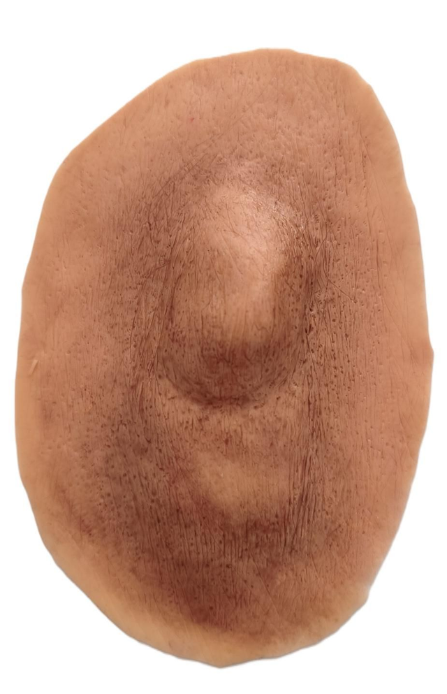 Κλειστό κάταγμα οστού 