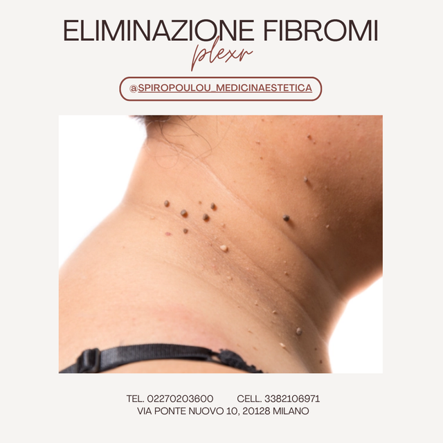 Eliminazione fibromi