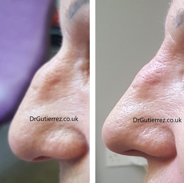 Rinomodelacion con hialuronico