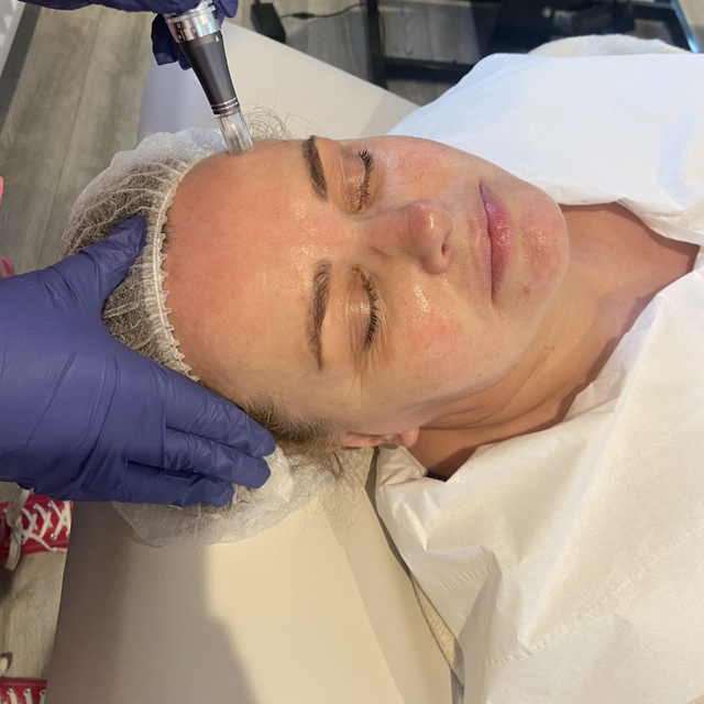 Microneedling course 
