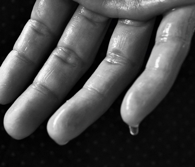 Sudoracion excesiva: hiperhidrosis 