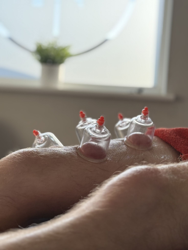 20 minutes Myofascial Dry Cupping