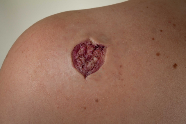 Schusswunde B - HD Prosthetic