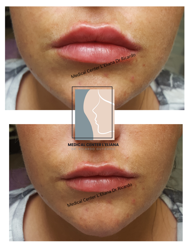 Relleno de labios con hialuronico