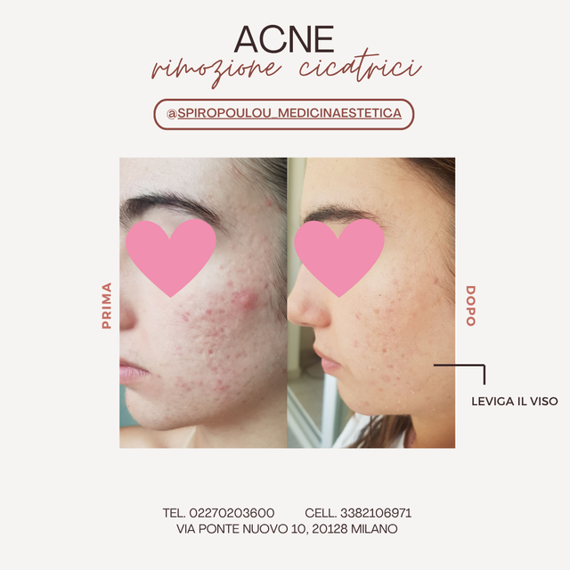 Peeling Trattamento acne