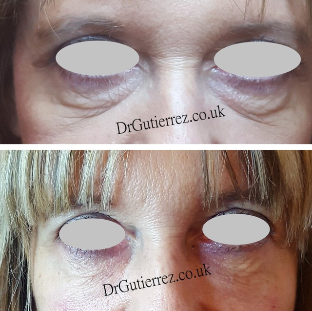 Ojeras (Tear trough), 1 vial