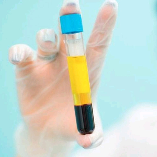 PRP plasma ricco di piastrine