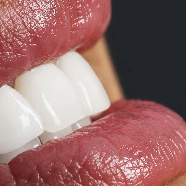 🦷 White 1 séance 