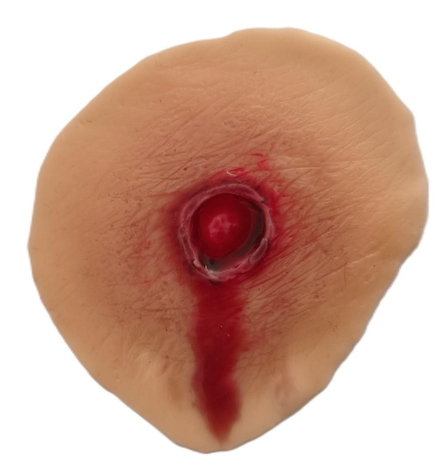 Πληγή από σφαίρα (εισόδου και εξόδου)