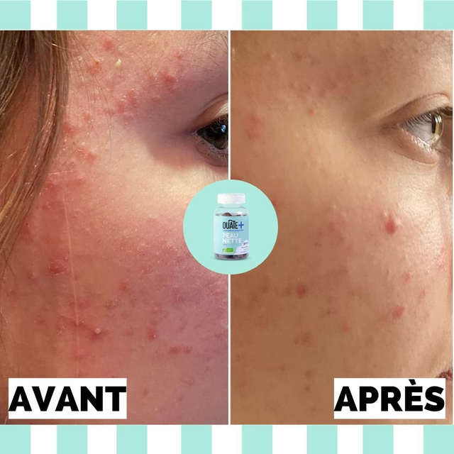 Mes gummies peau nettes sans sucre + 9 ans