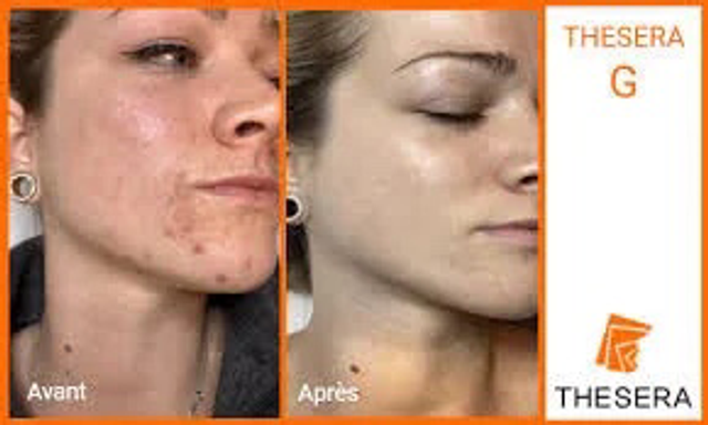 Thesera G