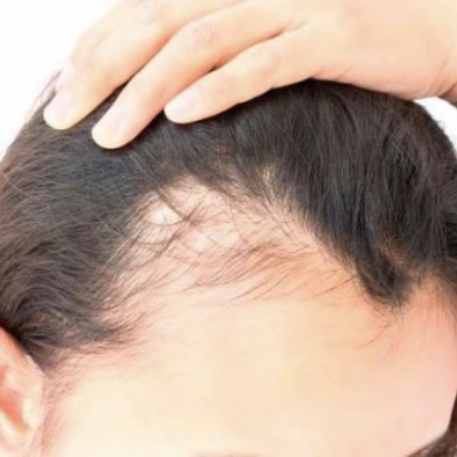 Caída de pelo MUJER