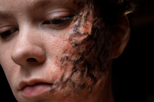 Brandnarben - HD Prosthetics