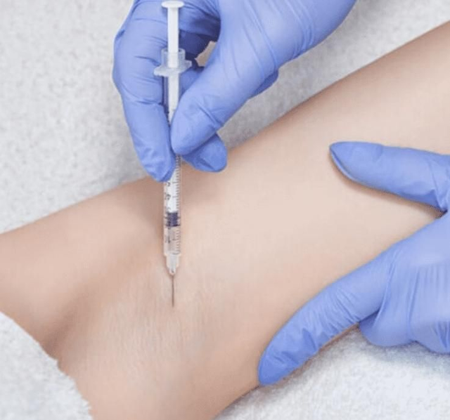 Iperidrosi (botulino)