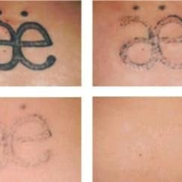Laser rimozione tatuaggio (a seduta iva esclusa)