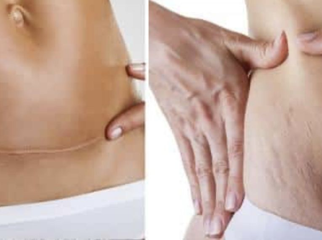 CICATRICI E SMAGLIATURE 