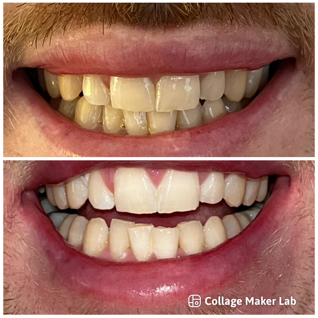 Blanchiment dentaire ( 1 séance ) 